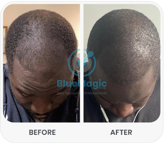 Hair transplant results by BlueMagic Group Ltd, with before and after images showing increased scalp coverage and improved hair thickness.